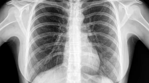 Chest radiograph